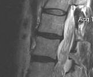 Spine MRI Normal and Degenerative Discs